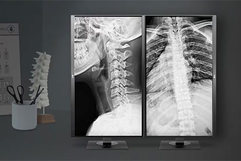 Medical display setup showing two X-ray images of the spine and chest, with a spine model on the desk in the foreground