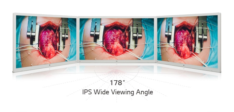 Experience vivid images on LG’s 55-inch 4K Display Surgical Monitor, equipped with an IPS panel that offers a wide 178° viewing angle.