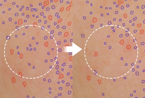 Image showing reduced pore size on the skin after use compared to before	